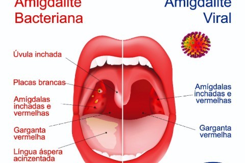 AMIGDALITE - DICAS DO DR. VICENTE